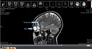 Moorfields Eye Hospital Dubai Performs a Complex Eye Surgery to Remove Massive Orbital Tumour